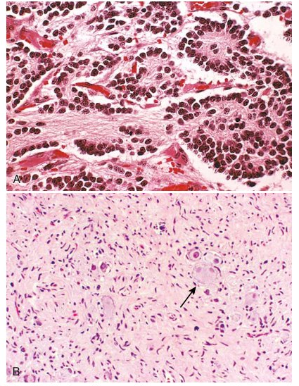 میکروگراف neuroblastoma و ganglioneuroma