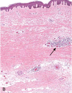 فیبروز پوستی در systemic sclerosis