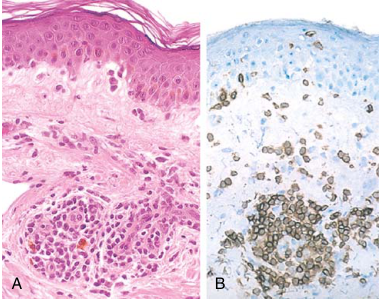 واکنش delayed-type hypersensitivity در پوست