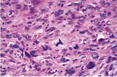anaplastic tumor with atypical mitosis