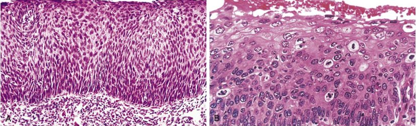 carcinoma in situ with intact basement membrane