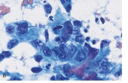 Papanicolaou smear with malignant cells