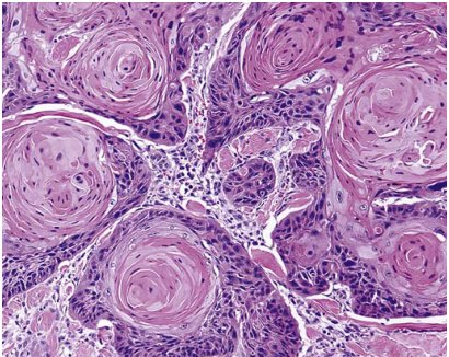 well differentiated squamous cell carcinoma with keratin pearls