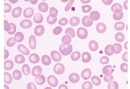 basophilic stippling در گلبول قرمز