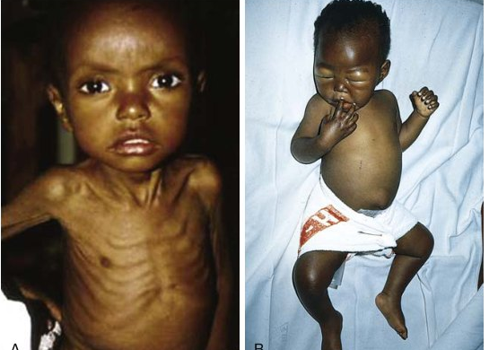 نمای بالینی marasmus و kwashiorkor